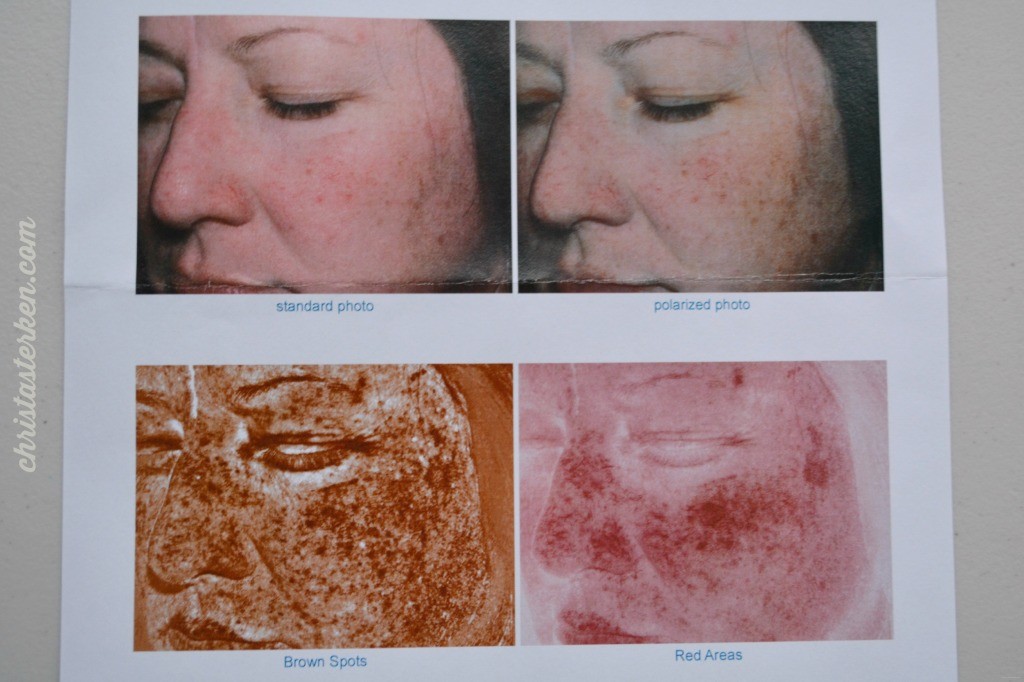 skin damage under ultraviolet rays